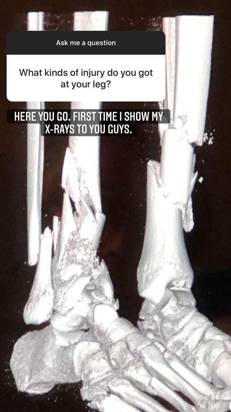 Juan Manuel Correa, a Formula 2 driver, shows the x-ray of his injured legs for the first time