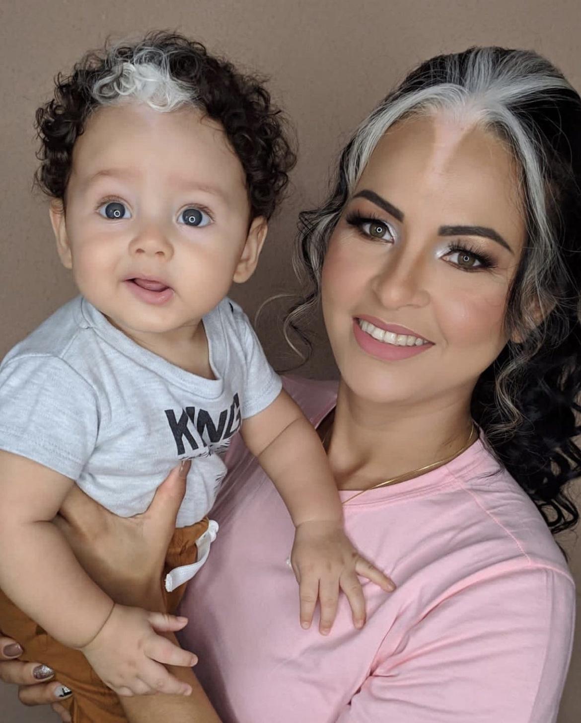 Mother and child with Poliosis