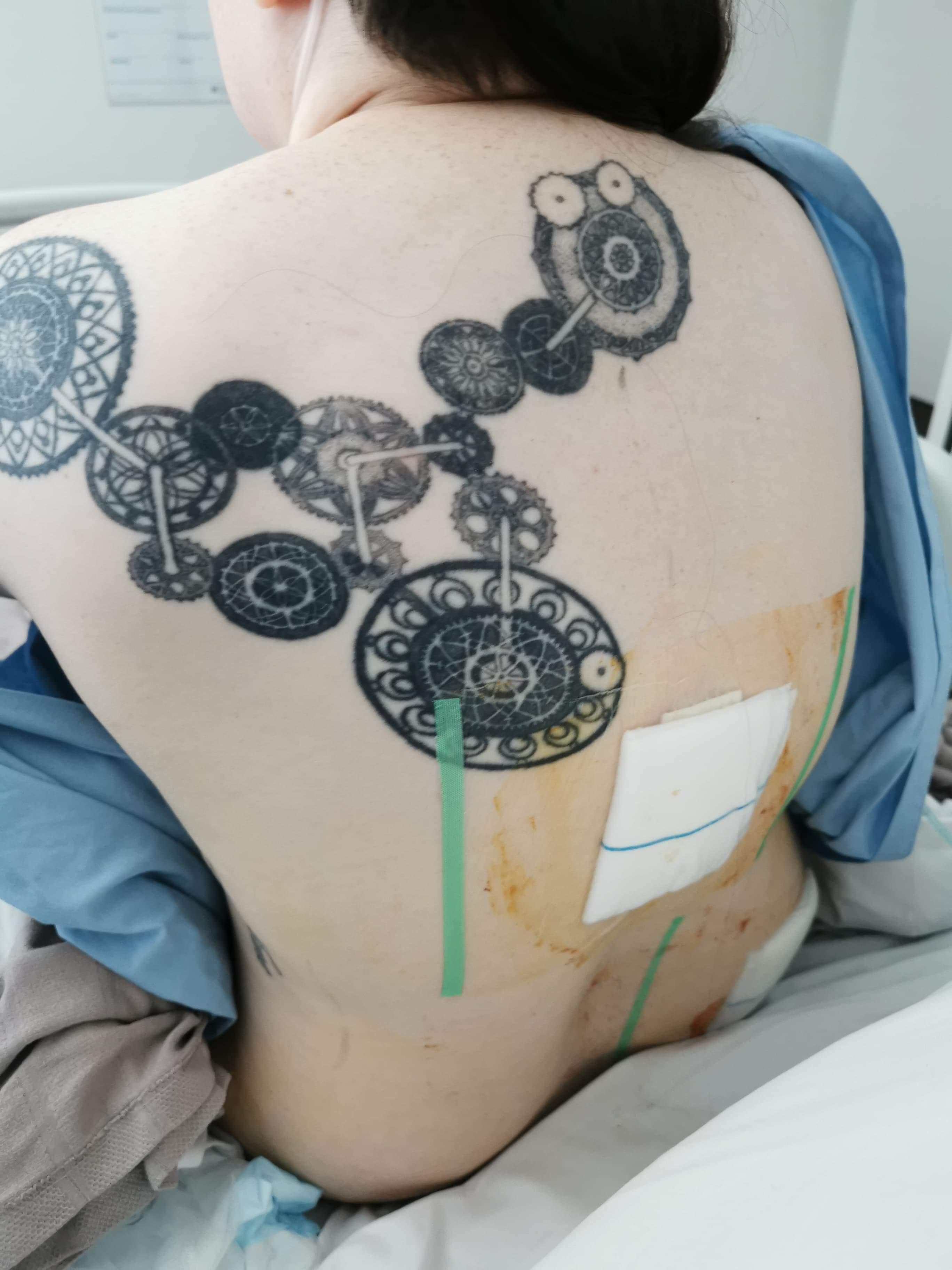 I finally got my permanent Spinal Cord Stimulator Implant