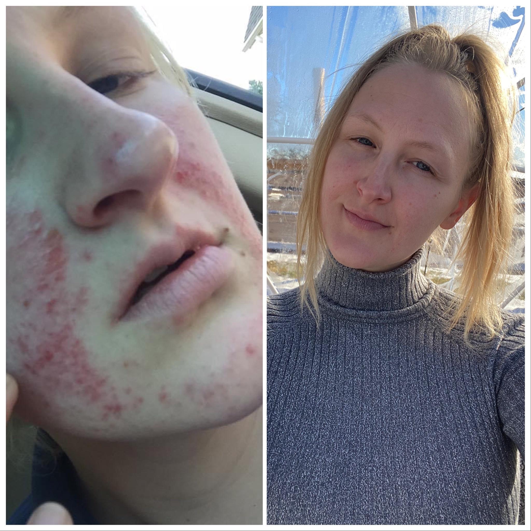 Officially 1 1/2 years in remission! (Lupus) Left is blood blistered face with steroids and chemo treatments and right is what I look like now sans makeup!